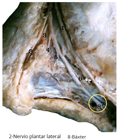 disección anatómica en la que se distinguien las ramas del nervio plantar lateral y el nervio de baxter