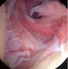 La capsulitis de hombro, también conocida como hombro congelado, es una afección que se produce cuando la cápsula articular del hombro se inflama y se endurece