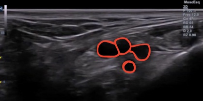 La ecografia del nervio tibial posterior y del paquete vasculo-nervioso tibial debes saber hacerla para poder detectar cambios tanto en el tendón como en las estructuras adyacentes.