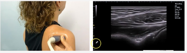 Corte de referencia en ecografía del labrum posterior del hombro