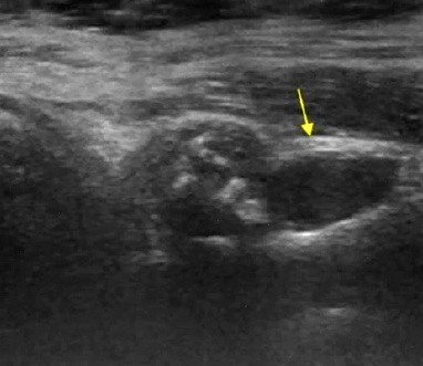 Ecografía del un labrum con quistes