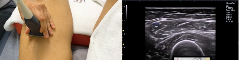 Corte de referencia en la ecografía del recto anterior