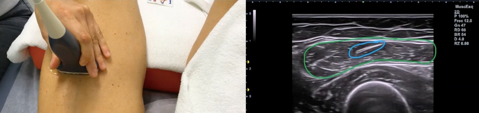 Corte de referencia en la ecografía del recto anterior con marcas de guía