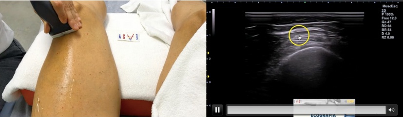 Ecografía del recto anterior