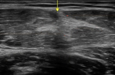 Ecografía de una rotura del recto anterior