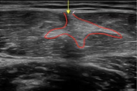 Ecografía de una rotura del recto anterior