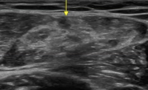 Ecografía de una rotura del recto anterior