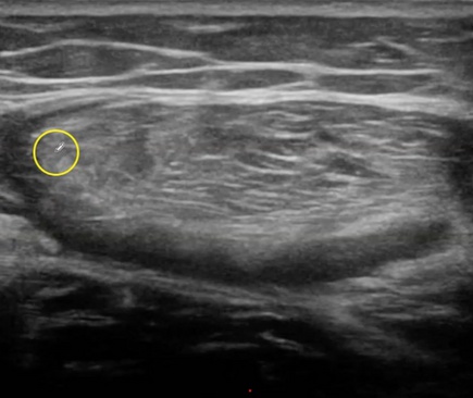 Ecografía de una rotura del recto anterior