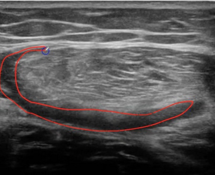 Ecografía de una rotura del recto anterior