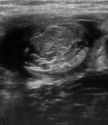 Ecografía de una rotura del recto anterior