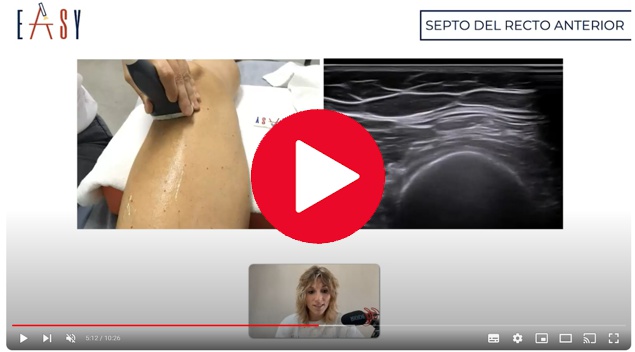 El recto anterior o femoral es uno de los cuatro fascículos musculares que componen el cuádriceps. Veamos anatomía y ecografía