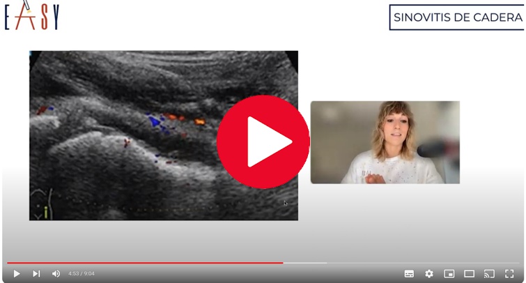 Video de ecografía en la sinovitis de cadera