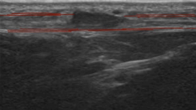 La fascitis plantar es una patología habitual la cual cursa con dolor en el talón debido a una inflamación de la fascia plantar.