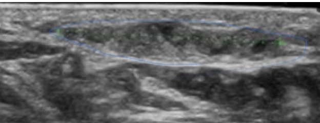 La fascitis plantar es una patología habitual la cual cursa con dolor en el talón debido a una inflamación de la fascia plantar.