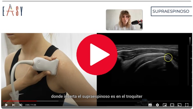 La rotura parcial del tendón supraespinoso aparece en pacientes de avanzada edad teniendo un abordaje exitoso a través del ejercicio.