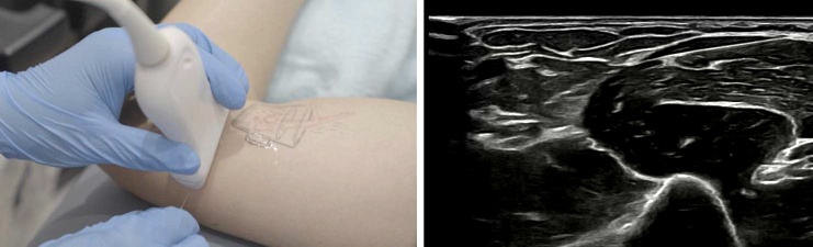 La neuropatía por compresión del nervio cubital, síndrome del túnel cubital, causa gran incomodidad y limita la función del brazo y la mano