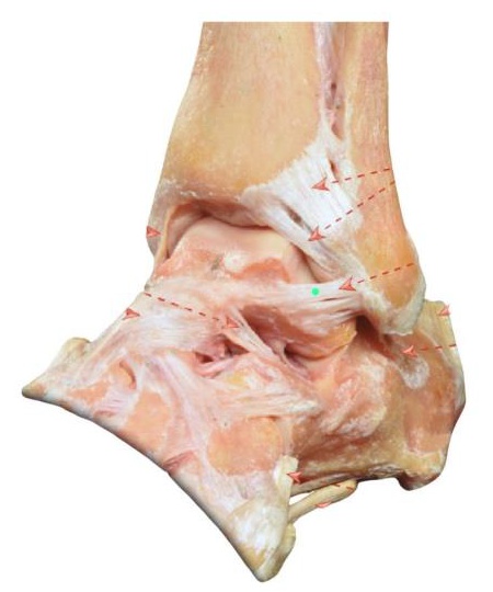 El esguince de tobillo, del ligamento de peroneo-astragalino anterior (LPAA) es la lesión más frecuente cuando el tobillo sufre una inversión forzada.