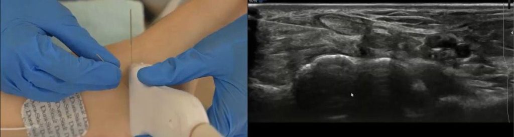 Tenosinovitis del tibial posterior, tratamiento invasivo