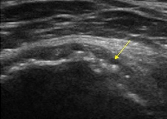 Calcificación de los tendones del glúteo medio y menor