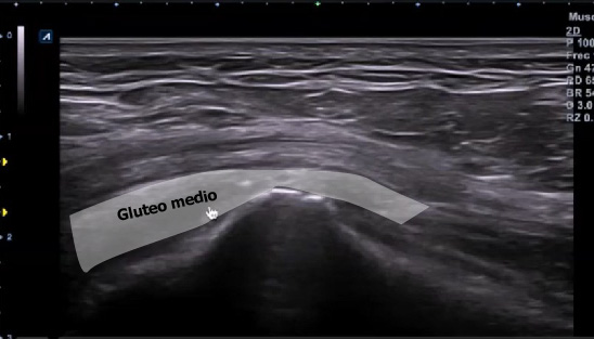 Corte longitudinal gluteo medio señalado