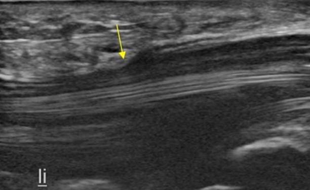 Imagen de ecografia de muñeca tunel del carpo