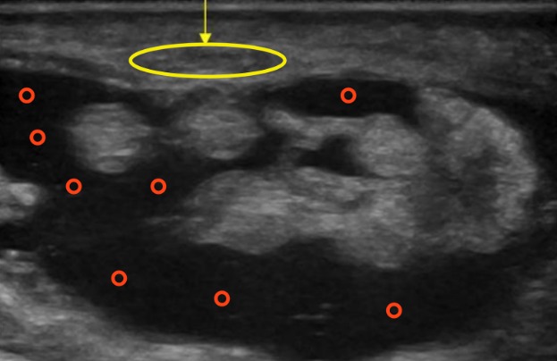 Imagen de ecografia de muñeca tunel del carpo