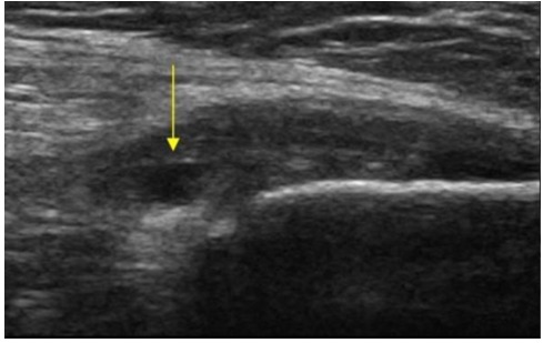 Tendinosis del glúteo medio