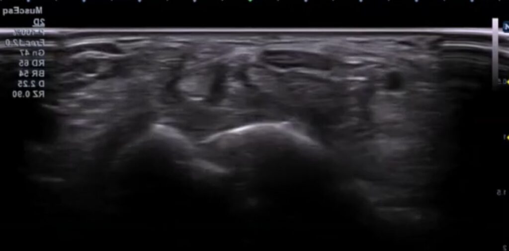 Corte ecografico tunel carpiano