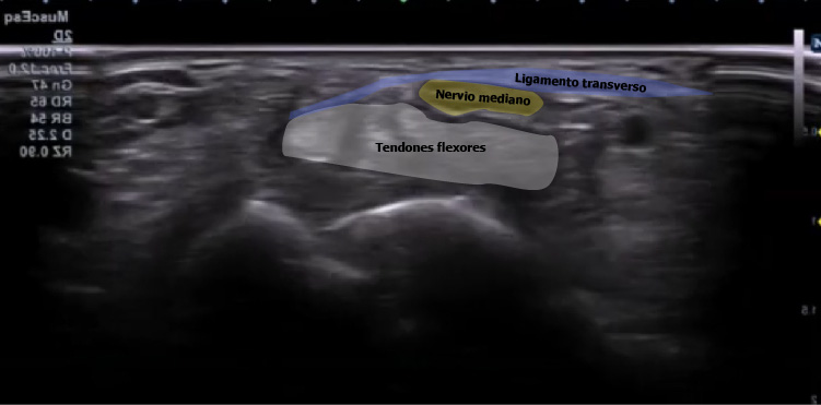 Corte ecografico tunel carpiano señalado