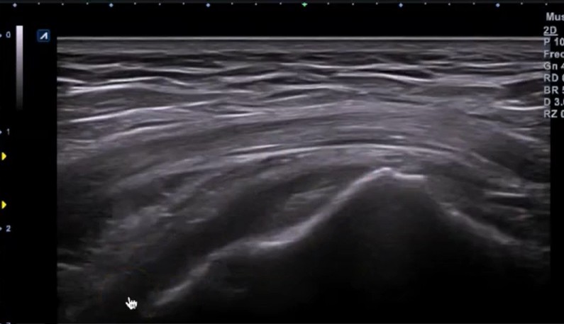 Corte longitudinal gluteo menor