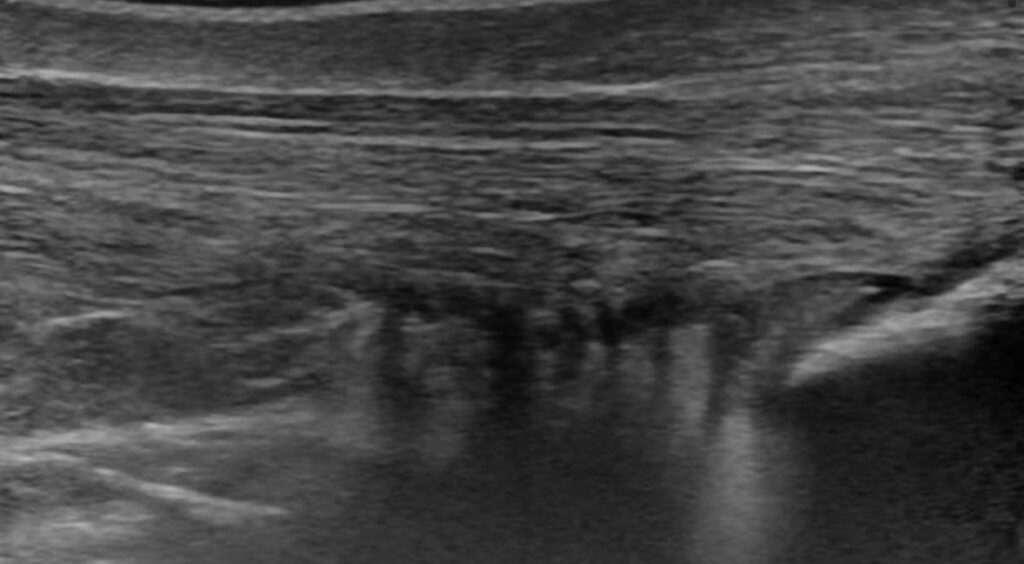 Alteración grasa de Kager