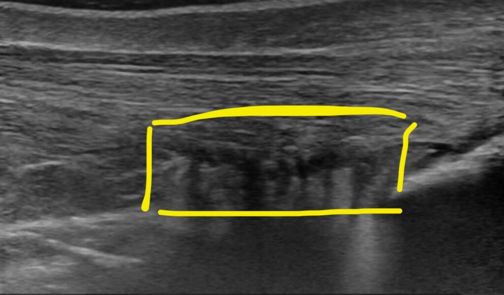 Alteración grasa de Kager señalada
