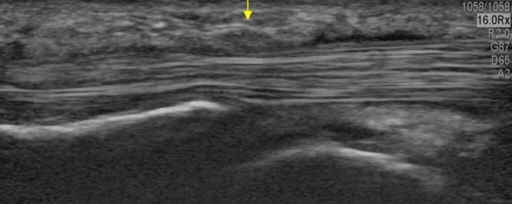 Dedo en gatillo - fibrosis de la polea