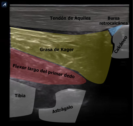Error más frecuente 1 al hacer ecografía tendinosa: no conocer la anatomía normal de la región a explorar