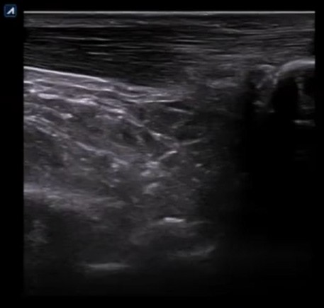 Ecografía tendón de Aquiles