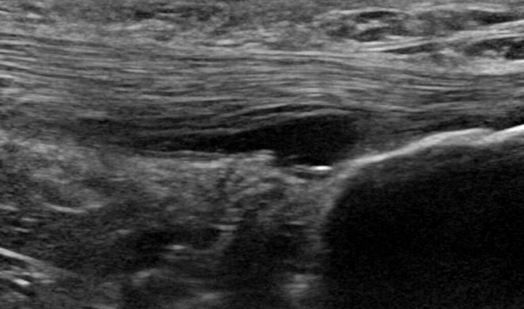 Rotura parcial tendón de Aquiles