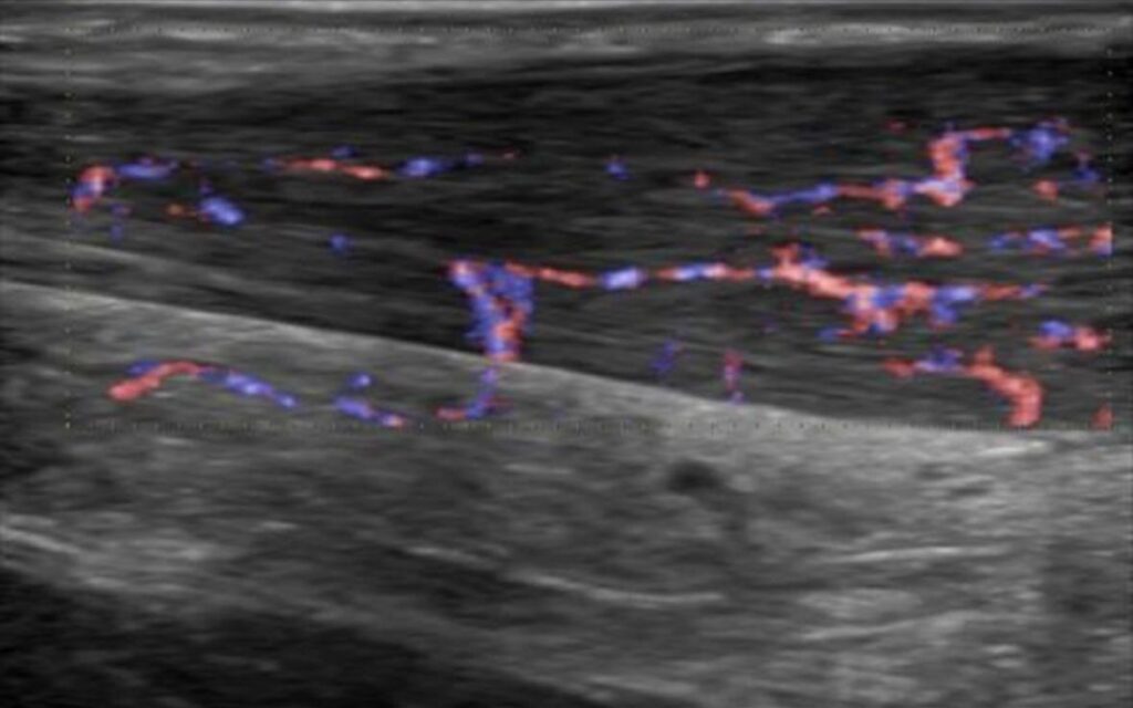 Tendinopatía del tendón de Aquiles