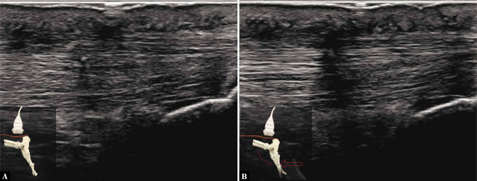 prueba ecografica flexion plantar 1 buena funcion