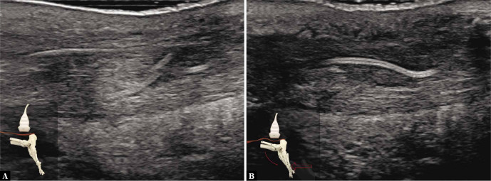 prueba ecografica flexion plantar 2 mala funcion