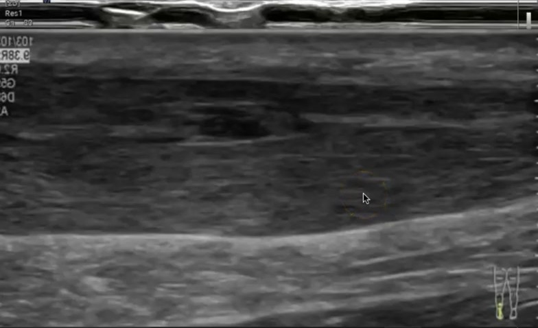 Imagen ecografica longitudinal de tendinopatia cronica tendon Aquiles