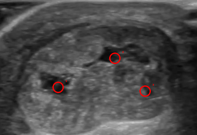 Imagen ecografica transversal de tendinopatia cronica tendon Aquiles con 3 focos hipoecoicos señalados
