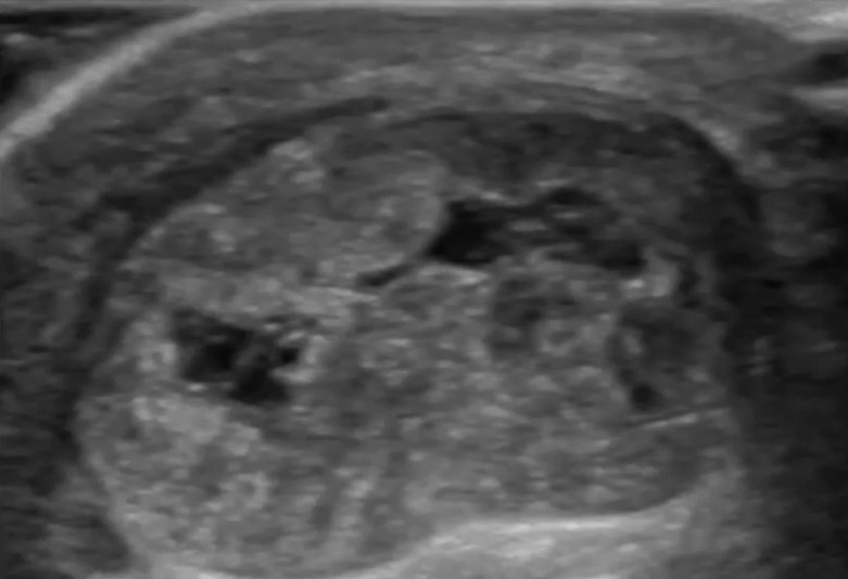 Imagen ecografica transversal de tendinopatia cronica tendon Aquiles