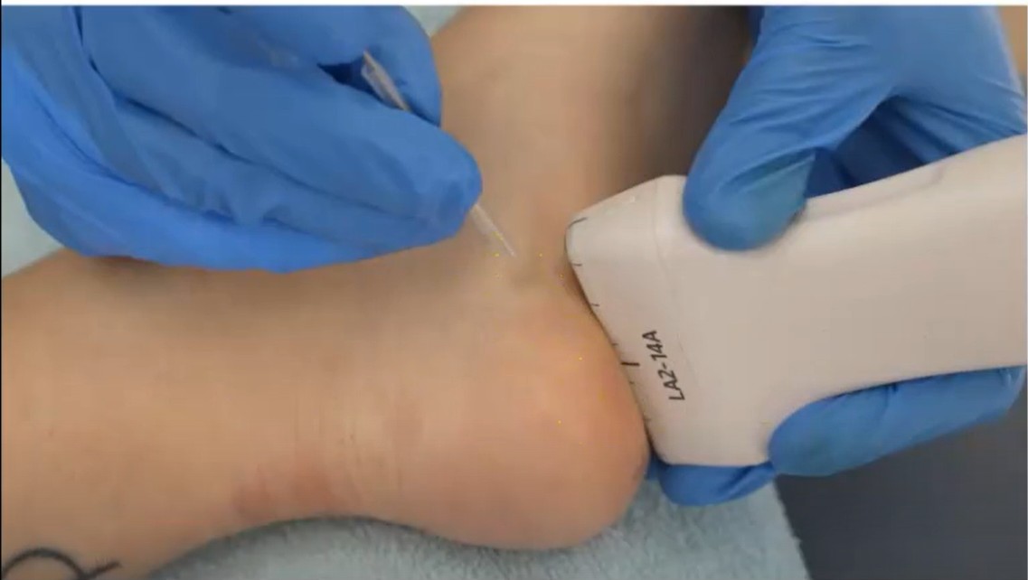 Imagen del procedimiento de electrólisis percutánea intratisular aplicada ecoguiadamente sobre la fascia plantar.