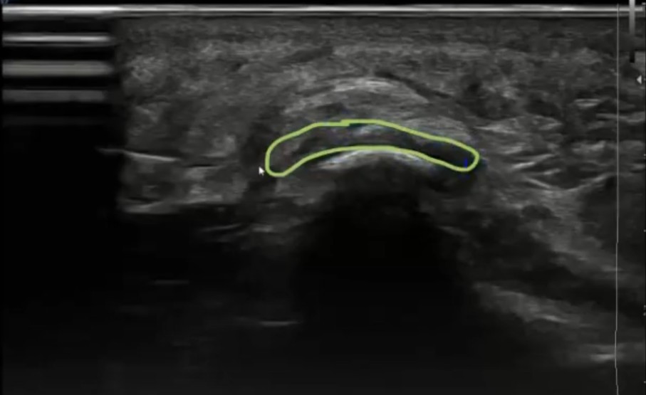 imagen ecografica en la que se observa la zona de la entesis de la fascia plantar y la agua mediante la cuál se realiza un abordaje invasivo en paciente con fascitis plantar crónica
