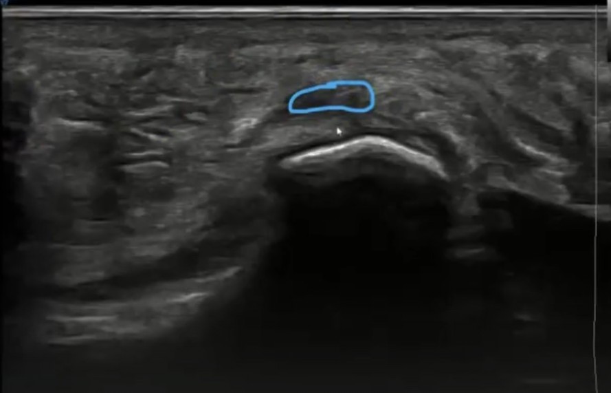 imagen ecografica en la que se observan zonas hipoecoicas en la fascia plantar en paciente con fascitis plantar crónica