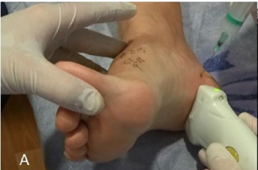 Infiltración ecoguiada de corticoide en la inserción proximal de la fascia plantar, con la aguja introducida desde abordaje medial.	
