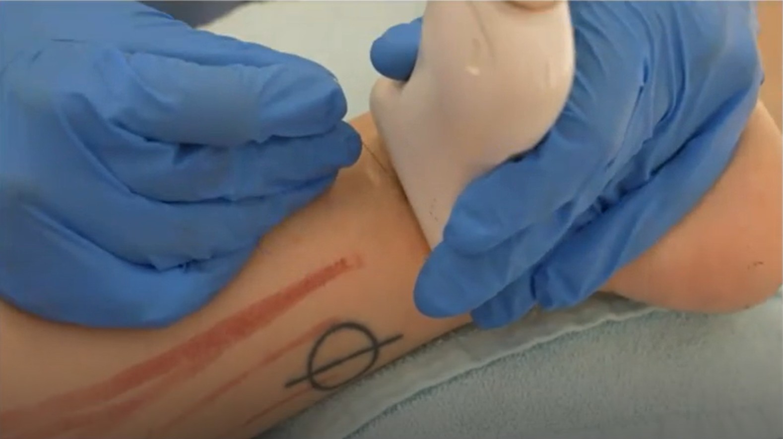 Fisioterapeuta aplicando estimulación eléctrica percutánea (PENS) en el nervio de Baxter para dolor plantar
