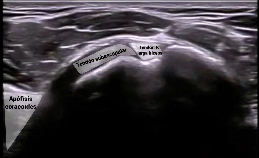 Imagen ecográfica del tendón del subescapular con referencias anatómicas señaladas Imagen ecográfica del tendón del subescapular con referencias anatómicas señaladas