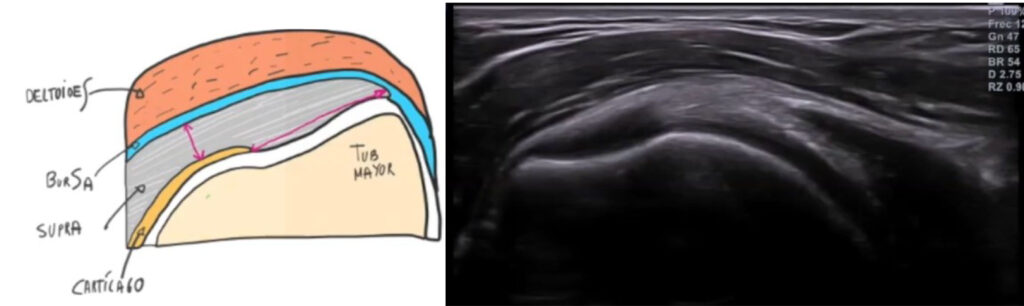 Imagen ecográfica del tendón del supraespinoso en un corte longitudinal Imagen ecográfica del tendón del supraespinoso en un corte longitudinal