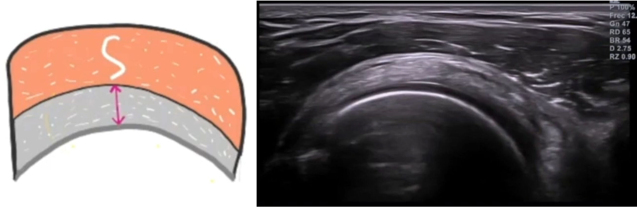 Imagen ecográfica del tendón supraespinoso sano en eje transversal